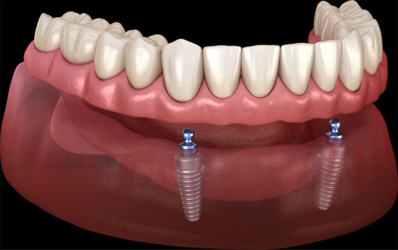 Lower Implant Supported over Denture