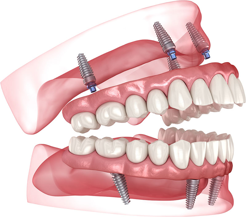 Permanent Zirconia Teeth cost both upper and lower