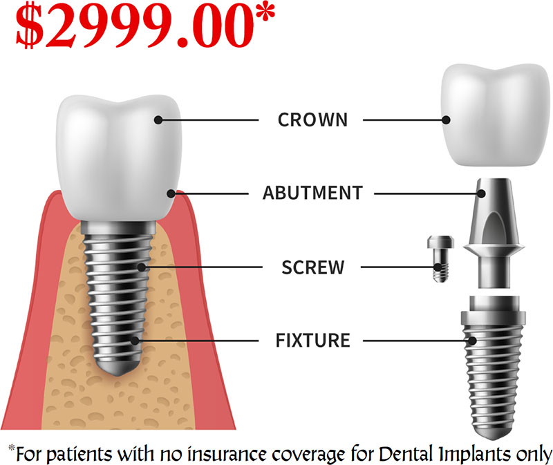 Dental implants Kent