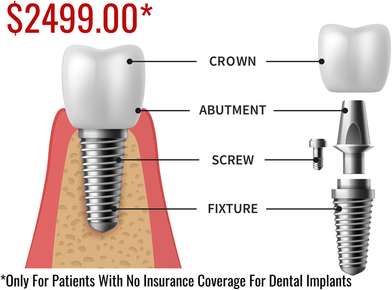 Dental Implants